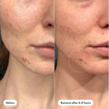 Invisible Daytime Hydrocolloid Acne Patches 39 Key Ingredients & Active Formula Highlight