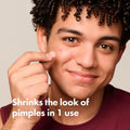 Original Hydrocolloid Acne Pimple Patches for Key Ingredients & Active Formula Highlight